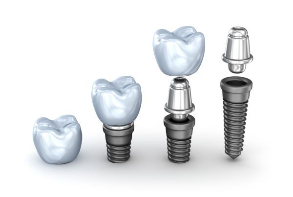 implantes dentales Toledo