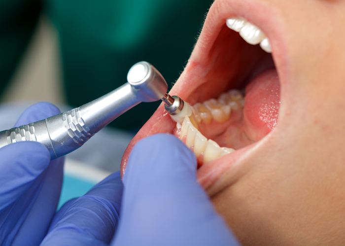 limpieza dental