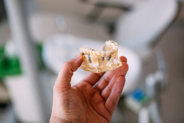 rechazar un implante dental