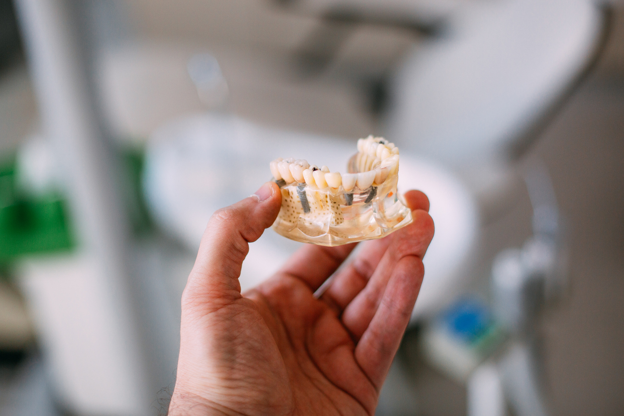 rechazar un implante dental