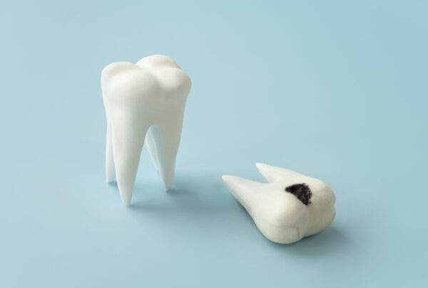 caries dental