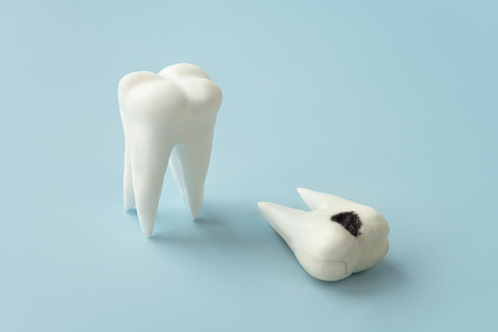 caries dental